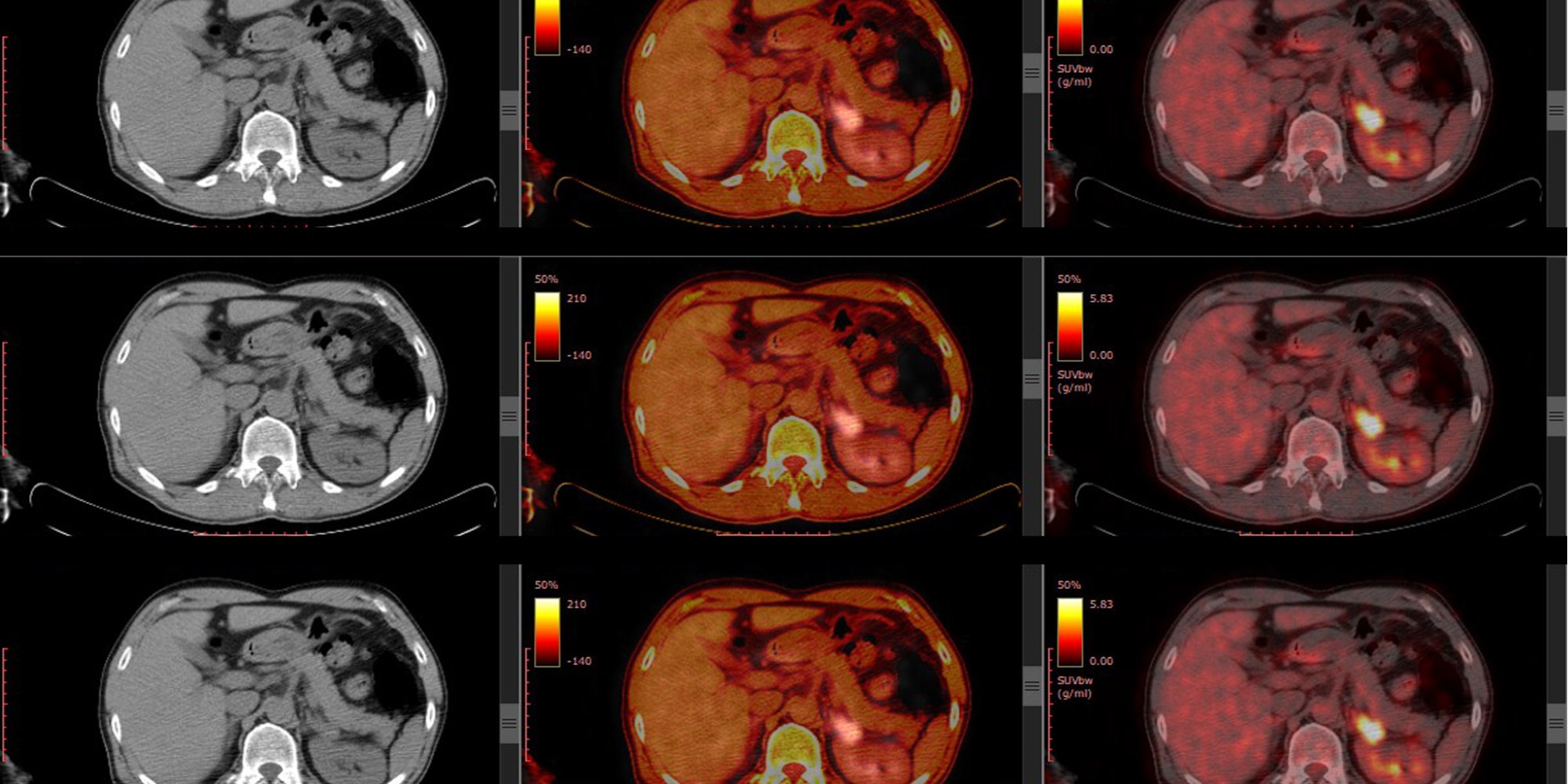 Reporting on a Phase II Study to Determine the Optimal Dosing Regimen for ⁶⁸Ga-satoreotide Trizoxetan As An Imaging Agent in Gastroenteropancreatic Neuroendocrine Tumors