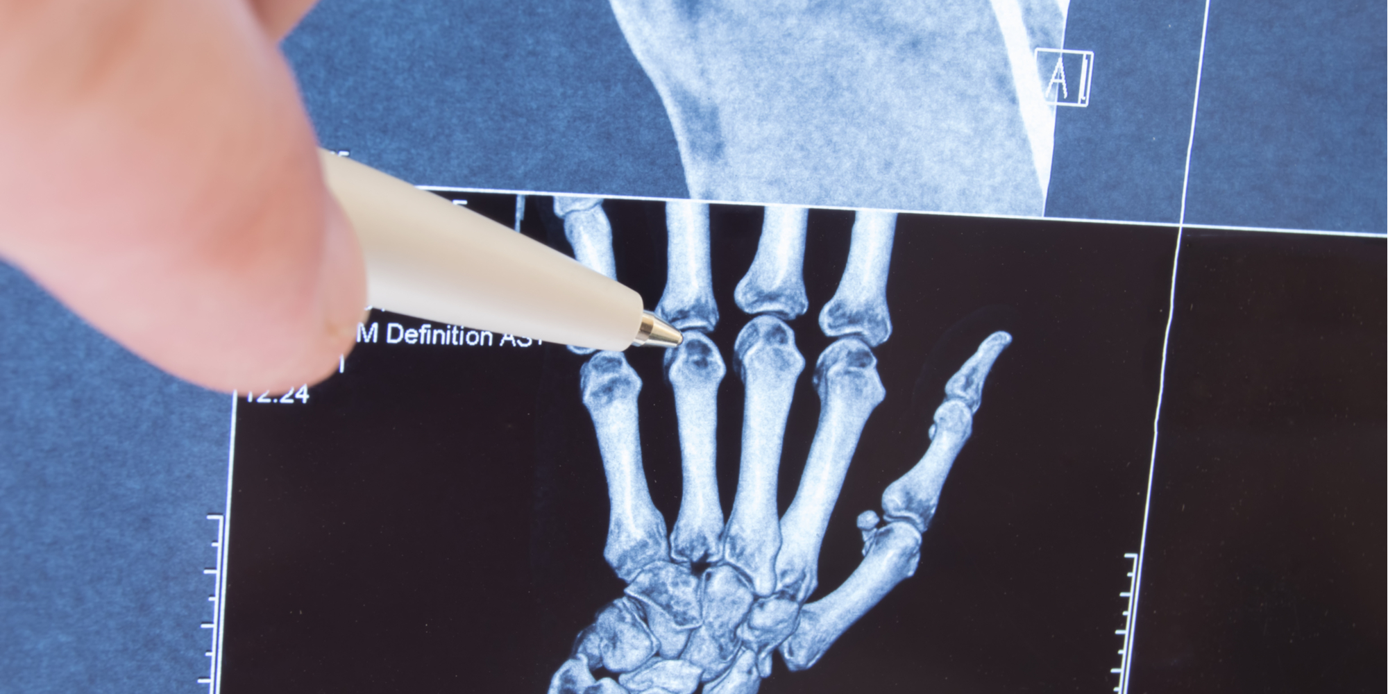 Consult with Disease & Tech Experts for RA Clinical Trials